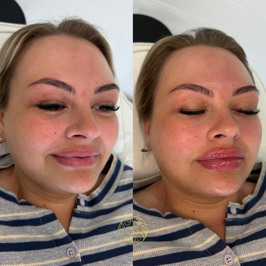 Before and after lip filler, a young woman with blonde hair in a striped top