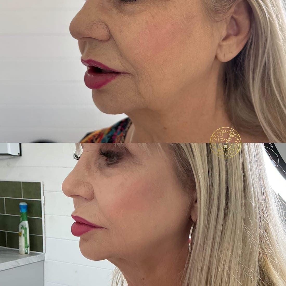Before and after, a woman with long blonde hair, lips and jawline in profile