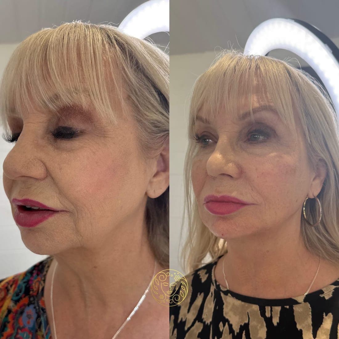 Before and after, an older woman with a blonde fringe, lips, cheeks and lower face in three-quarter view