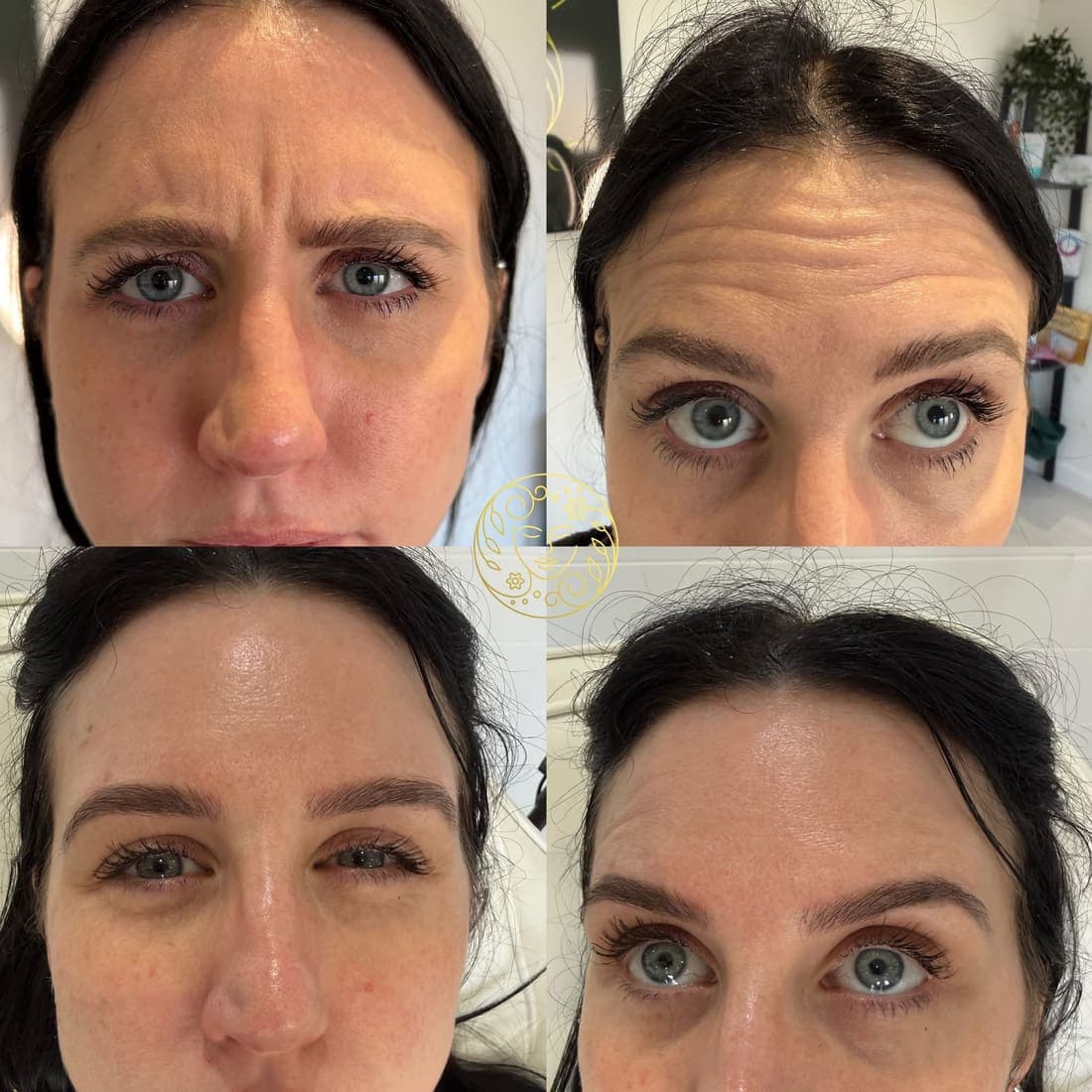Before and after anti-wrinkle treatment, a dark-haired woman's forehead and frown lines in four views