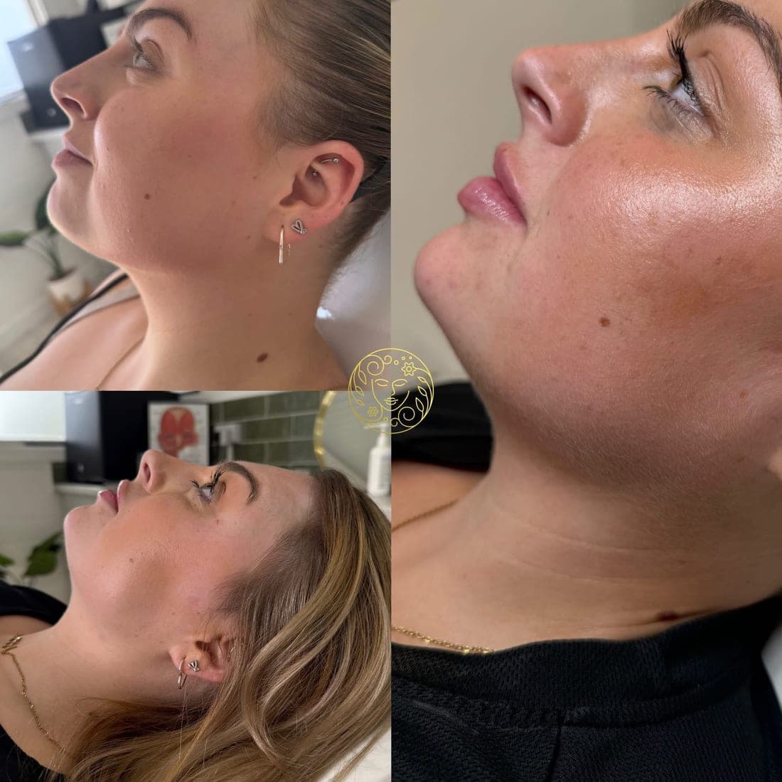Before and after, a young woman's jawline and chin in profile, from several angles