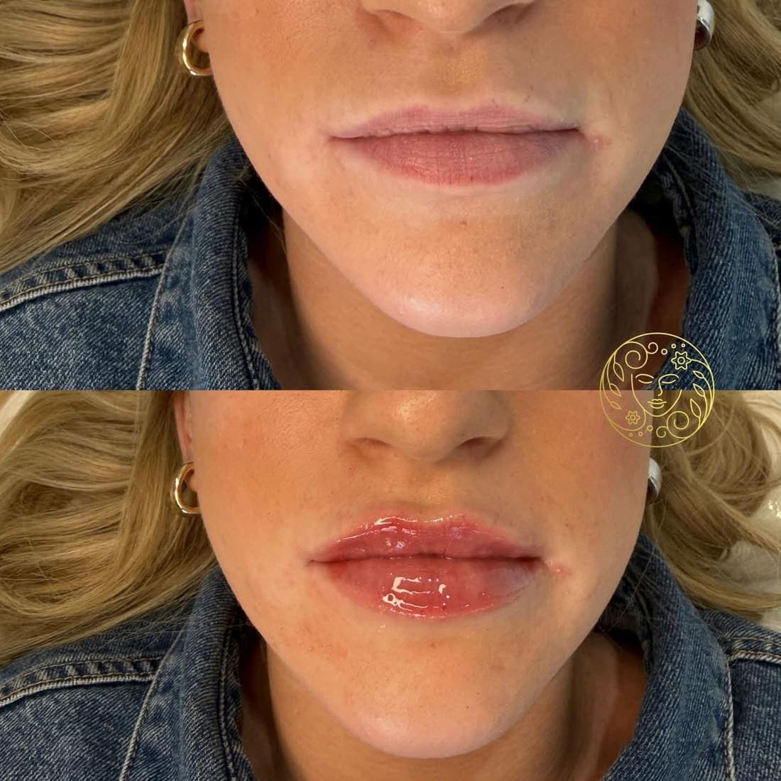 Before and after lip filler, close up of a young woman's lips, blonde hair and a denim jacket