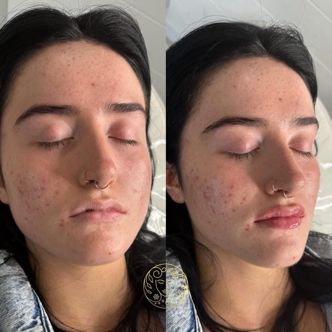 Before and after, a young woman with dark hair and a nose ring, skin and lips from the front