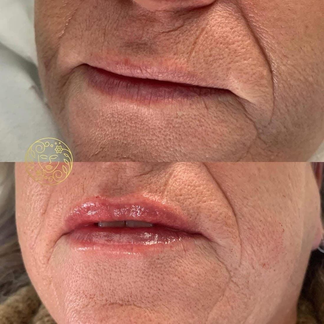 Before and after lip filler, close up of an older woman's lips