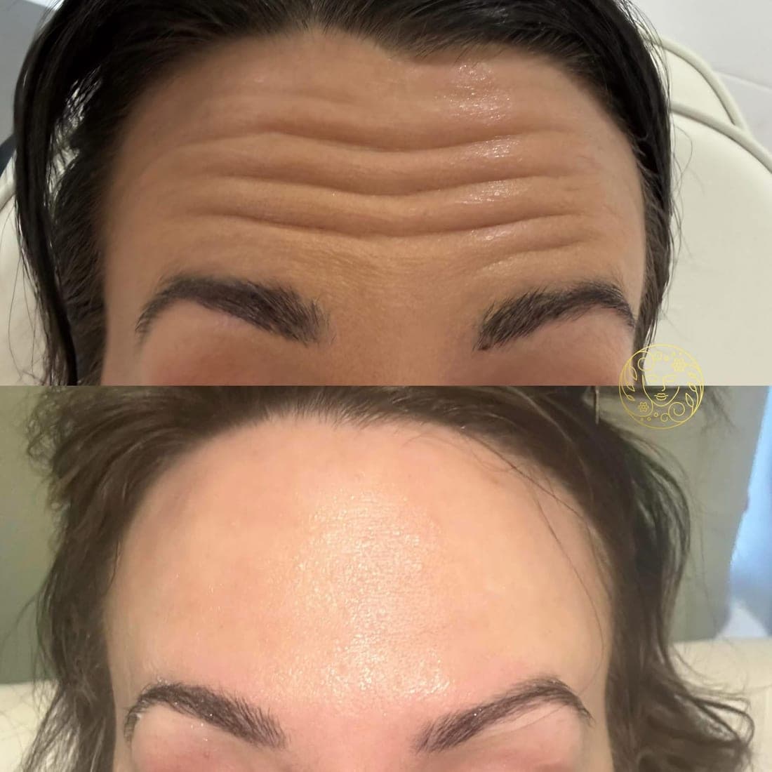 Before and after anti-wrinkle treatment, deep forehead lines on a woman with dark hair