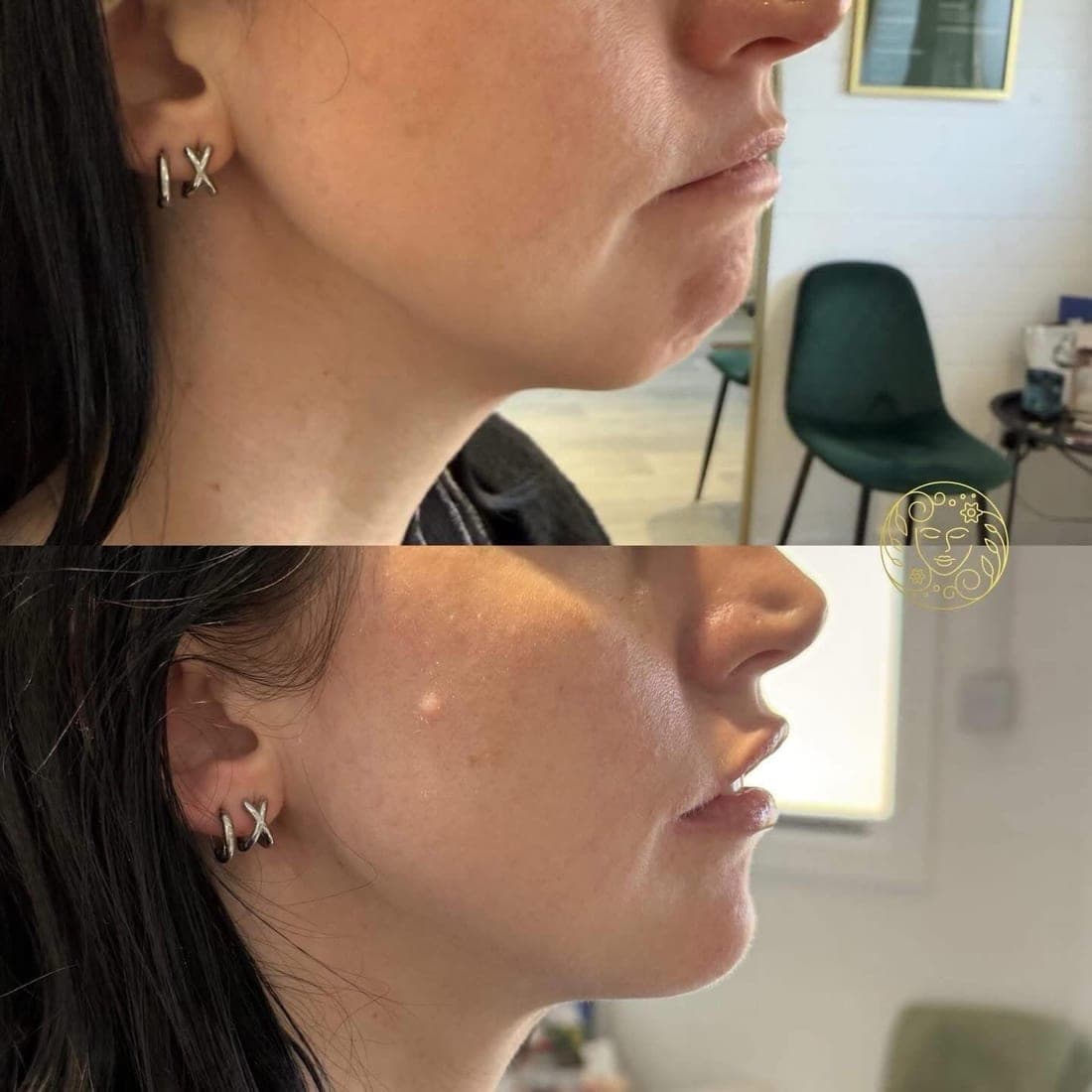 Before and after, a dark-haired woman's chin and jawline in profile
