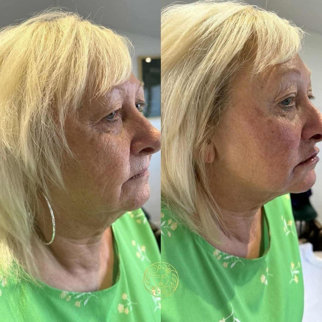 Before and after, an older woman with blonde hair, cheeks and jawline in profile