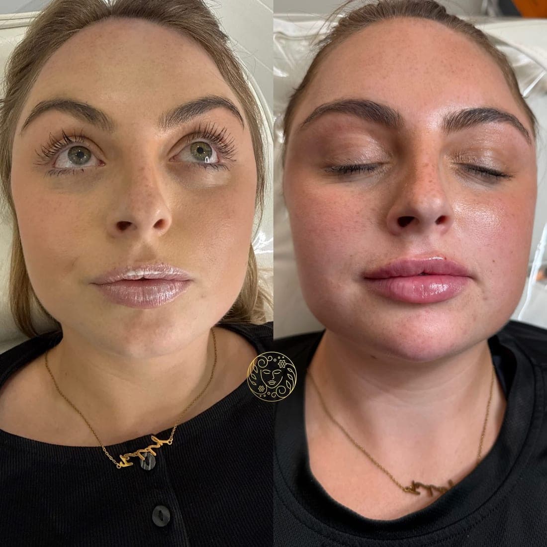 Before and after lip filler, a young woman with light brown hair, full face from the front