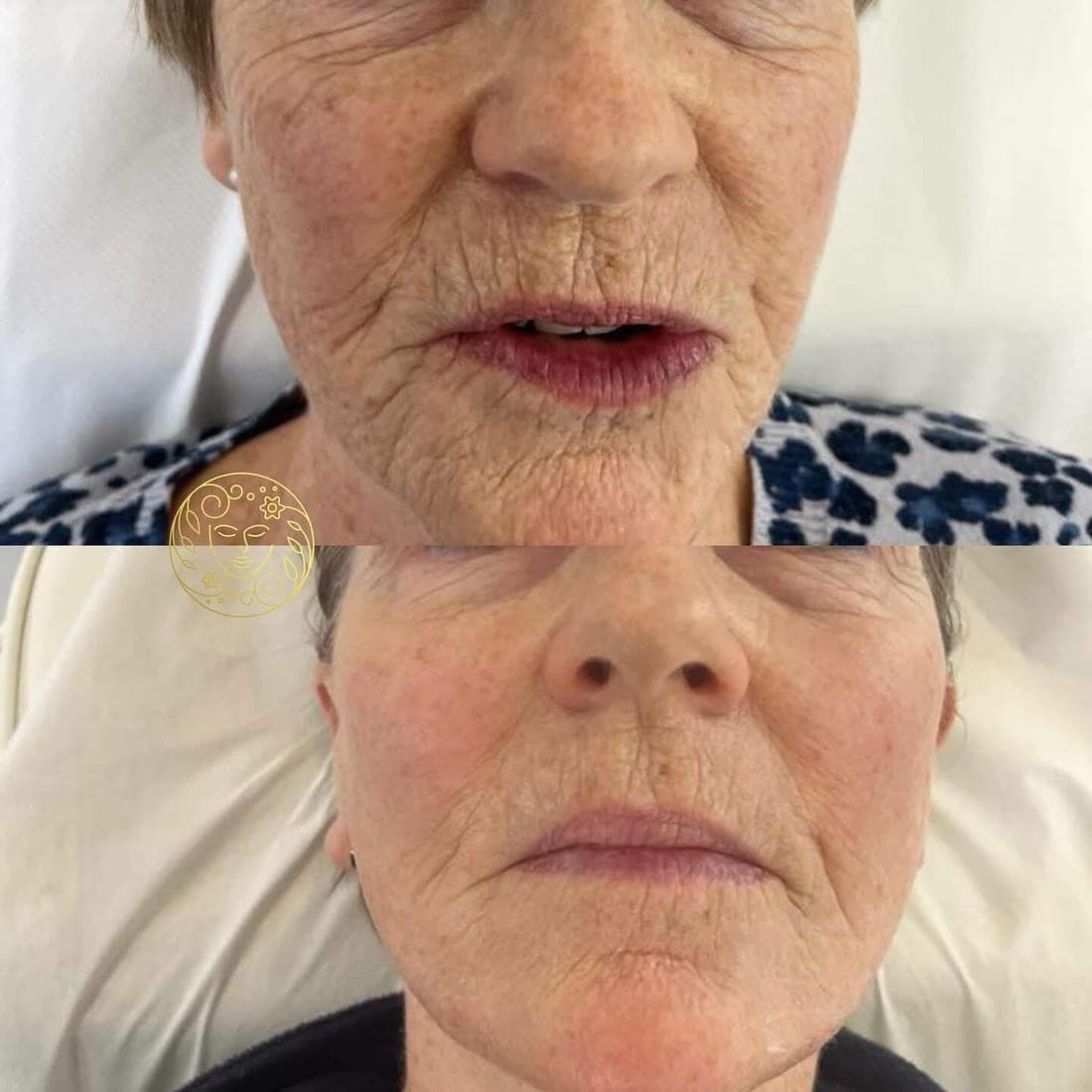 Before and after, an older woman's lips and the lines around her mouth, front view