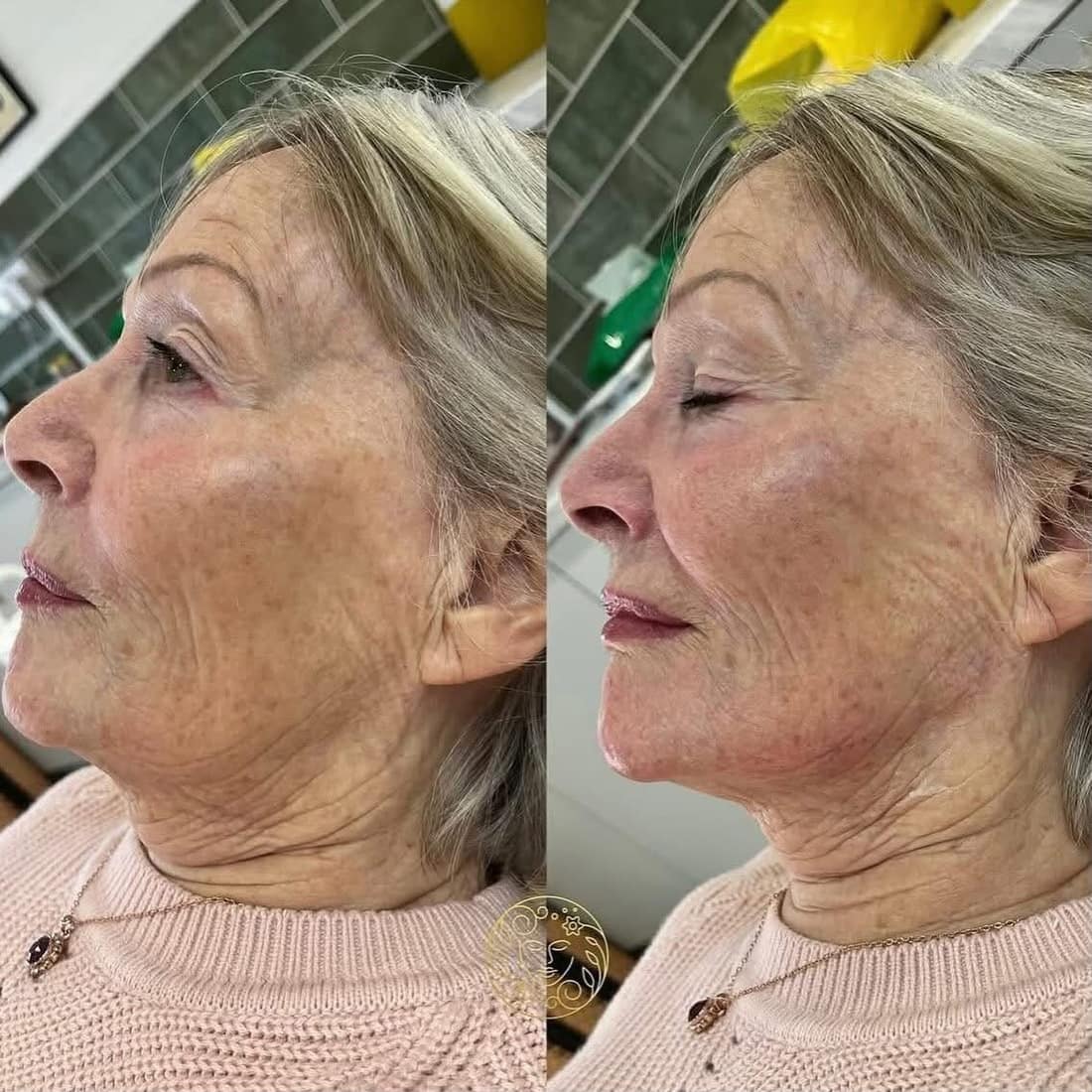 Before and after, an older woman's jawline and neck in profile