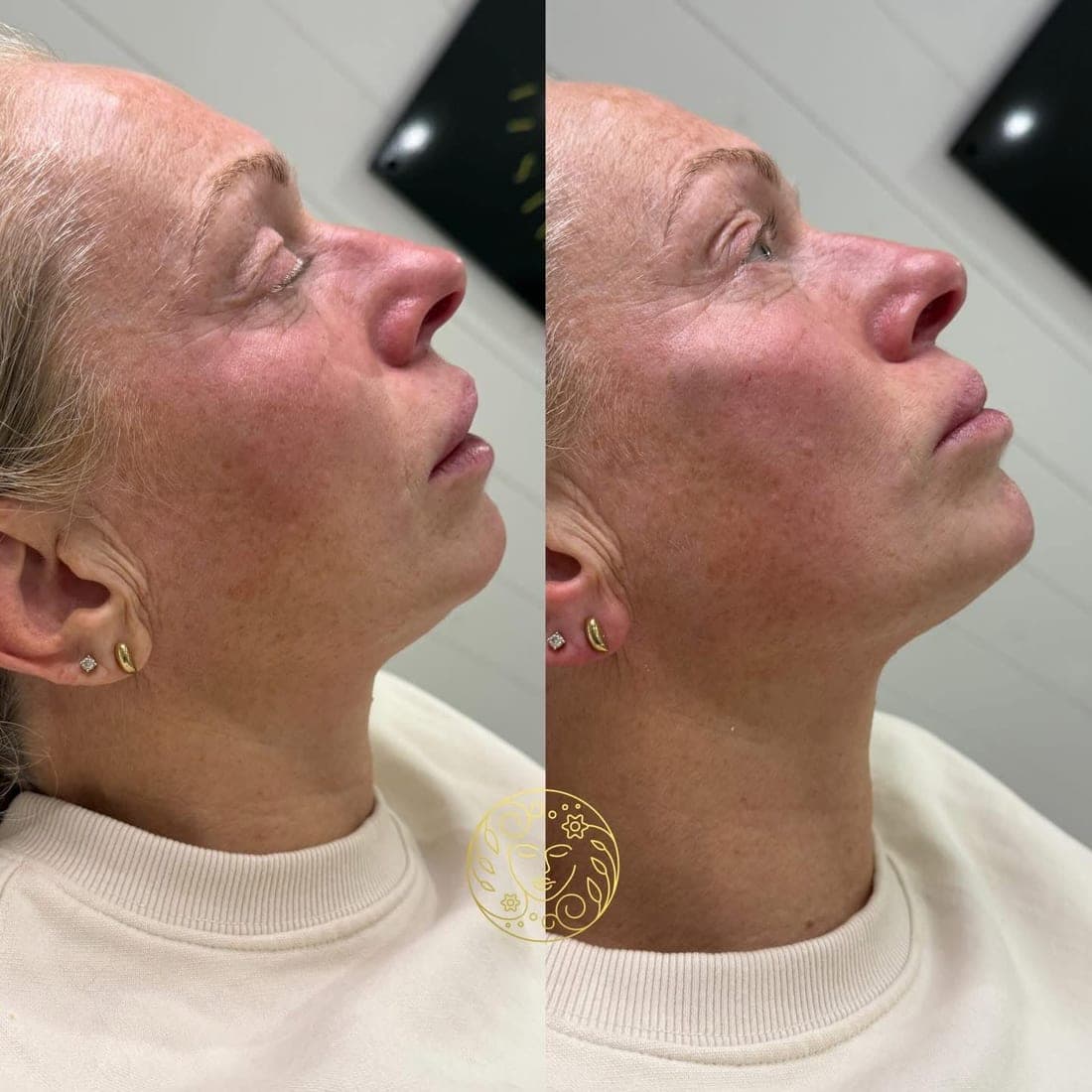 Before and after, a woman's skin in profile with her eyes closed