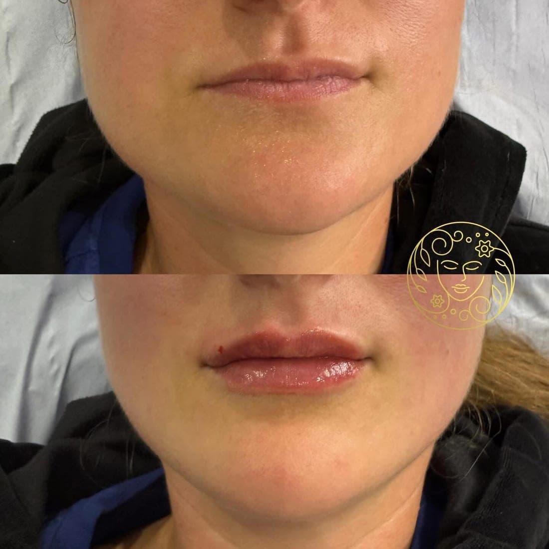 Before and after lip filler, close up of a woman's lips and chin