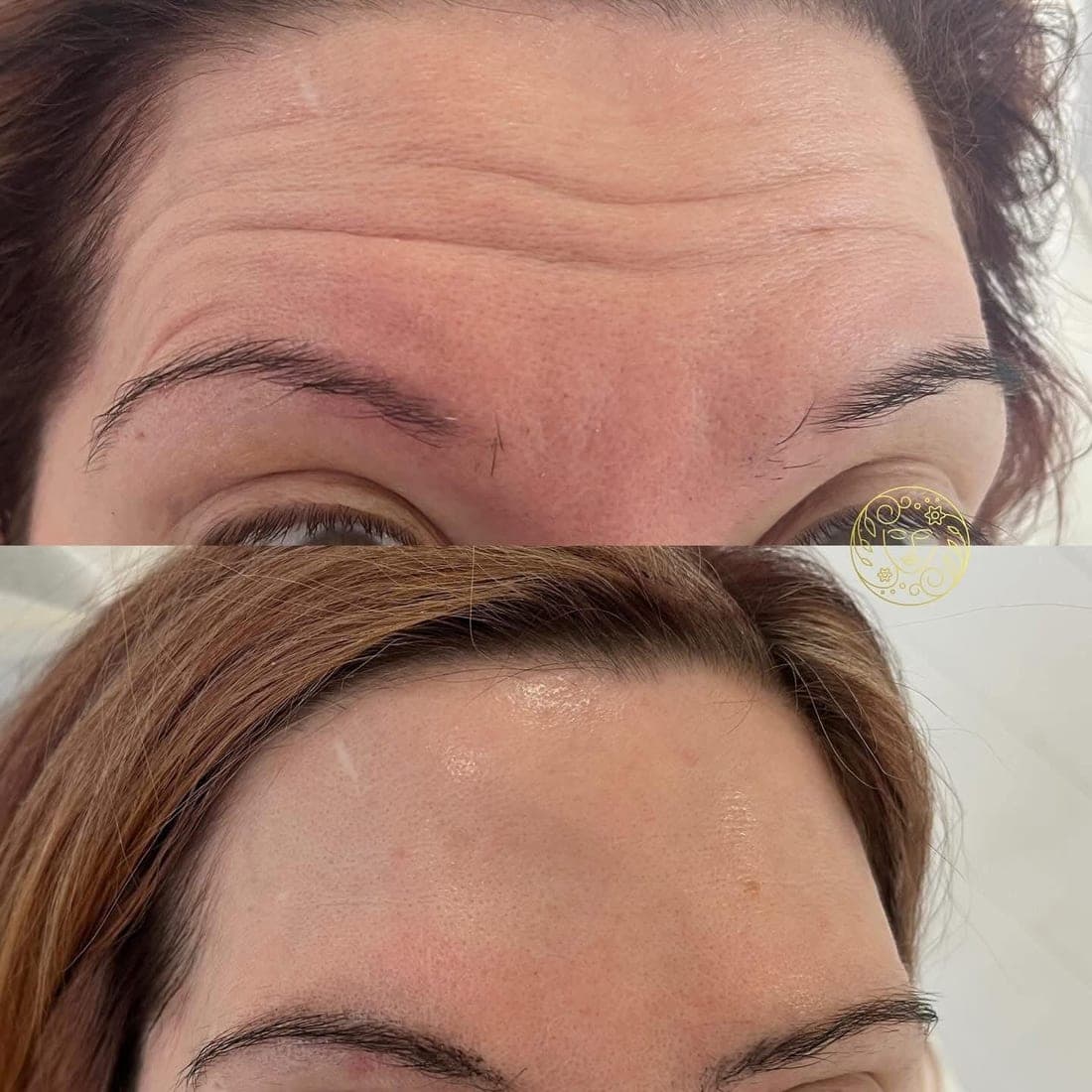 Before and after anti-wrinkle treatment, close up of a woman's forehead lines