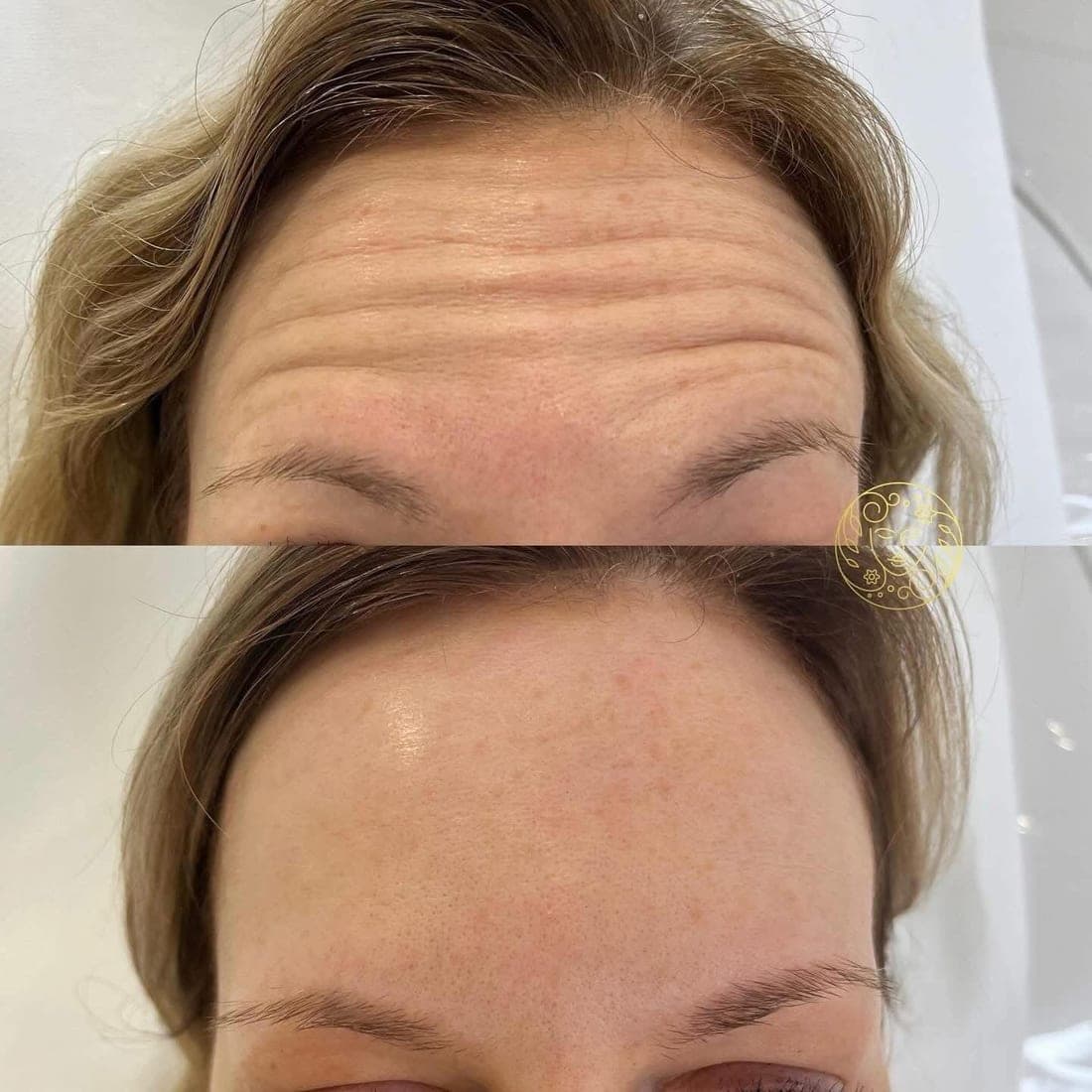 Before and after anti-wrinkle treatment, forehead lines on a woman with light brown hair
