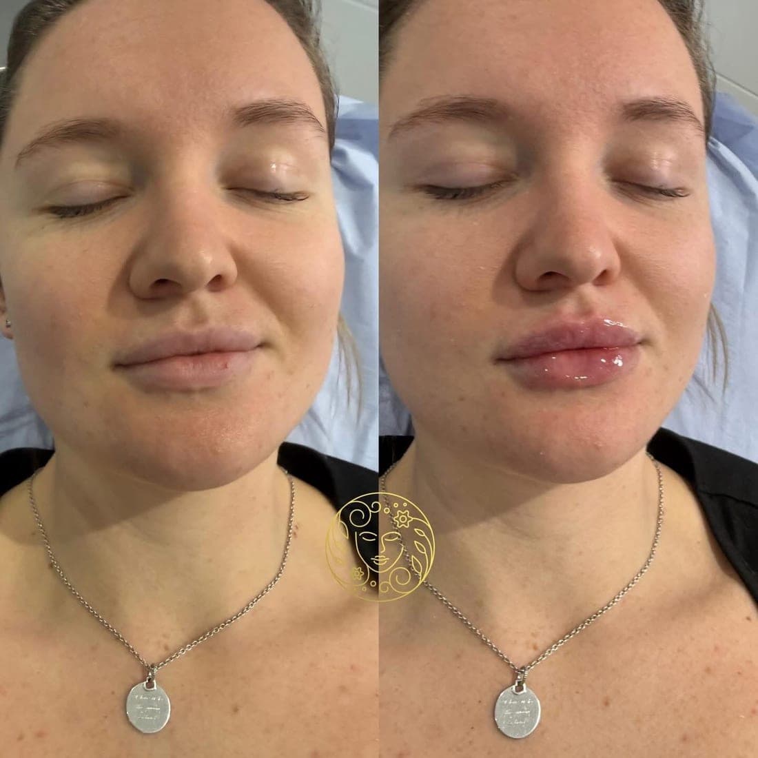 Before and after lip filler, a woman with her eyes closed, front view