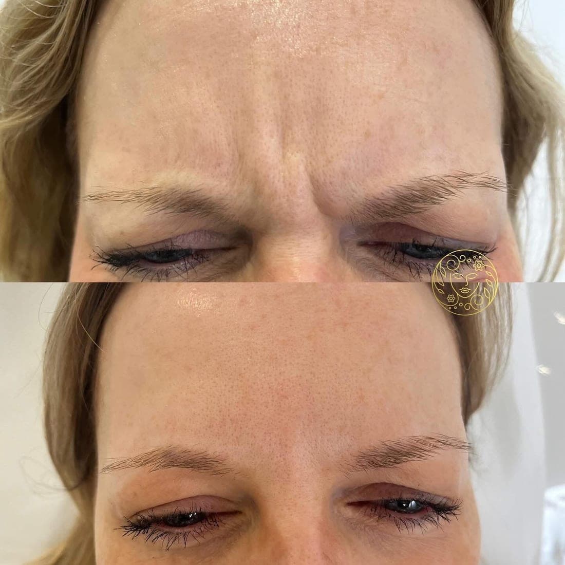 Before and after anti-wrinkle treatment, a blonde woman's frown lines