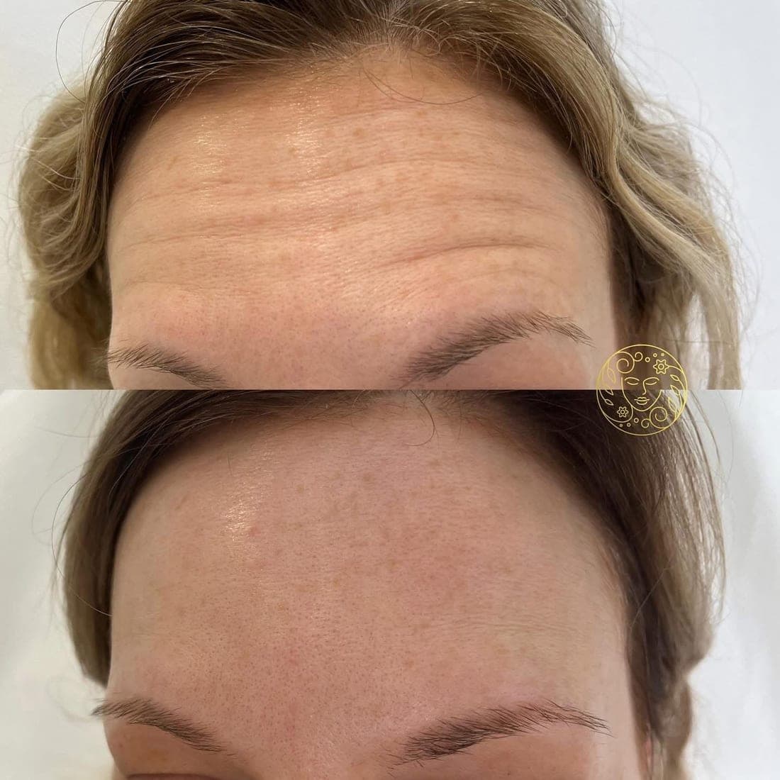 Before and after anti-wrinkle treatment, forehead lines on a woman with blonde hair