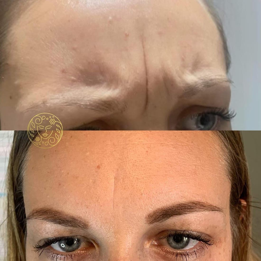 Before and after anti-wrinkle treatment, frown lines between a woman's eyebrows
