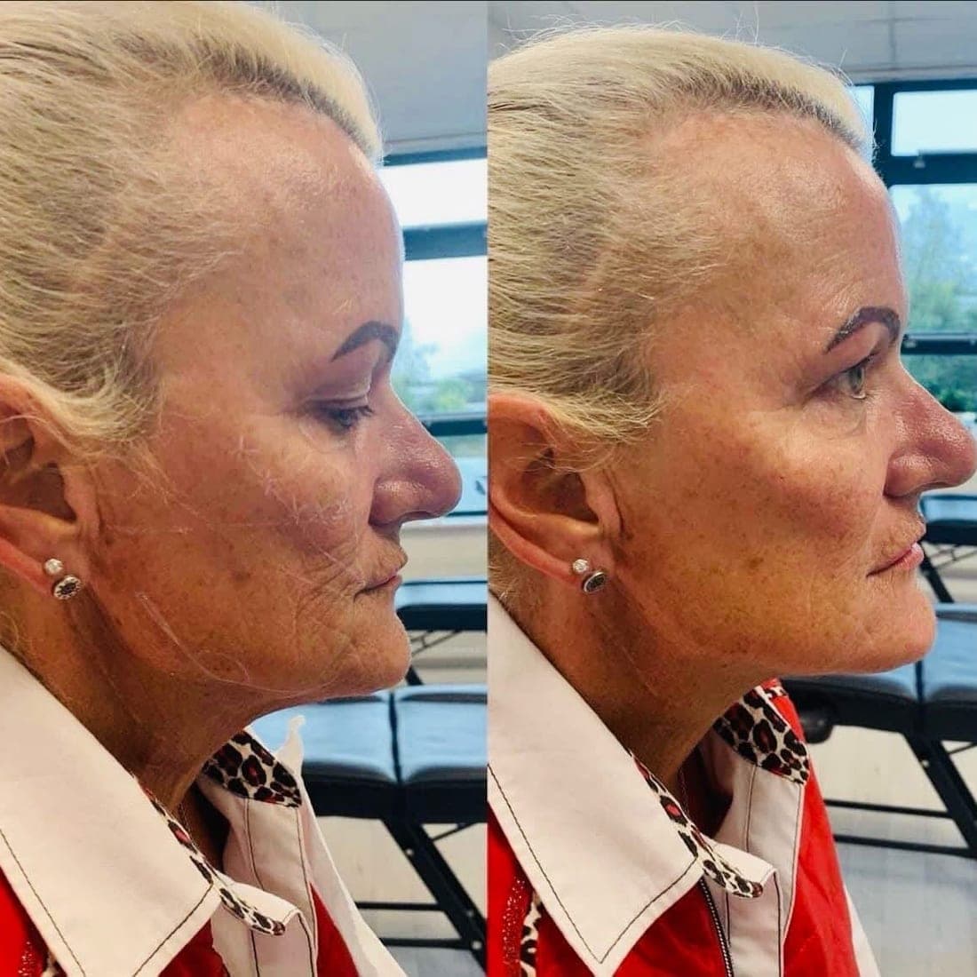 Before and after, an older woman with blonde hair, skin in profile